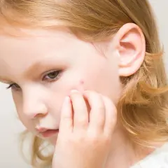 Un petit bouton rouge sur la joue d'une fillette aux cheveux blonds, peut-être un bouton de la 5ème maladie.