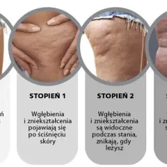 Cellulit na udach i pośladkach: skuteczne metody i zabiegi
