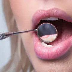 Usta kobiety z lusterkiem dentystycznym badającym zęby. Dowiedz się, jaka jest leczenie odwapnienia zębów cena.