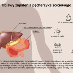 Ilustracja przedstawia anatomię jamy brzusznej z zaznaczonym zapaleniem pęcherzyka żółciowego. Wymienione objawy to ból, wzdęcia, wymioty i dyskomfort.