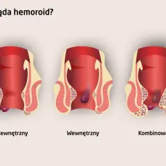 Ilustracja pokazuje zewnętrzne, wewnętrzne i kombinowane hemoroidy. Wczesne objawy raka odbytu mogą być mylone z hemoroidami.