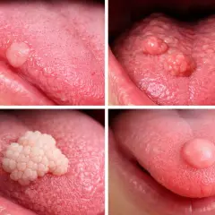 Differenti noduli sulla lingua, alcuni simili a piccole escrescenze, altri più grandi e carnosi, che possono causare dolore alla lingua.
