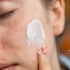 Kwas azelainowy i retinol to składniki aktywne w pielęgnacji skóry. Krem nakładany na twarz, widoczne piegi i zaczerwienienia.