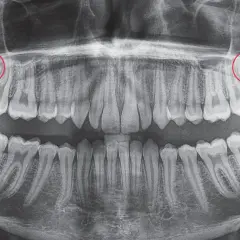 Radiografía panorámica dental. Se observan cuatro muelas del juicio impactadas, con posible hematoma tras extracción.