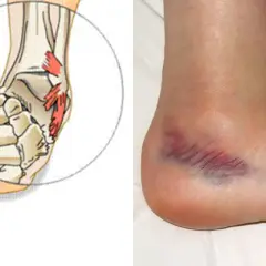 Illustrazione anatomica dei legamenti della caviglia e foto di una caviglia con ematoma, indicativi di un trauma.