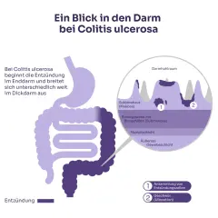 Colitis ulcerosa Symptome: Warnsignale, die Sie nicht ignorieren sollten