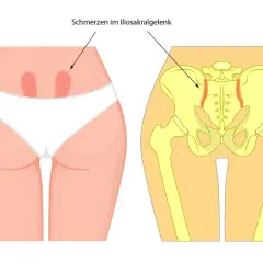 Iliosakralgelenk entzündung symptome: So erkennen Sie die Schmerzen