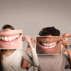 Kolor zębów A1 czy A2 - jak wybrać idealny odcień dla siebie?