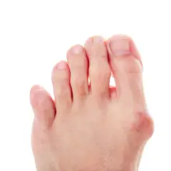 Piede con alluce valgo e dita leggermente piegate, suggerimenti su come raddrizzare le dita dei piedi.