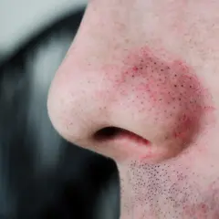 Gros plan sur un nez humain avec des pores dilatés et des points noirs visibles, la peau est légèrement irritée et rouge.
