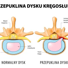 Porównanie zdrowego i przepukliny dysku kręgosłupa. Widoczny ucisk na korzeń nerwowy w przypadku przepukliny.