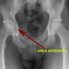 Radiografia del bacino che mostra un'anca artrosica, con il tipico "scrocchio" dovuto all'usura della cartilagine.