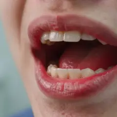 Podrażnione dziąsła? Sprawdzone sposoby i kiedy iść do dentysty