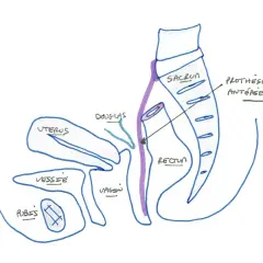 Schéma pelvien montrant l'utérus, la vessie, le vagin, le rectum, le sacrum et une prothèse antérieure. Illustration pour la convalescence après opération d'un prolapsus.