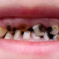 Jak wyleczyć próchnicę bez dentysty? Kiedy to możliwe?