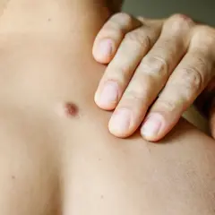 Dłoń dotyka skóry z widocznym włókniakiem. Jak usunąć włókniak twardy? Konsultacja lekarska jest kluczowa.