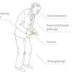 Diagnostik Parkinson Krankheit: So erkennen Sie die Symptome rechtzeitig