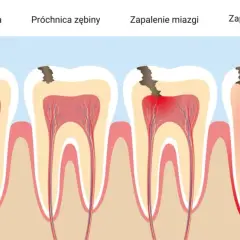 Ból zęba: czy to zapalenie miazgi? Rozpoznaj kluczowe objawy!