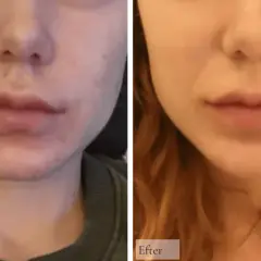 Före och efter bilder visar en hud med hyperpigmentering behandling. Huden är klarare och jämnare efter behandlingen.