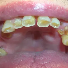 Boca con dientes desgastados y caries. Si los de abajo se mueven, los de arriba se caen.