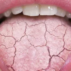 Lengua agrietada y seca, indicando posible boca ardorosa. Busca un tratamiento natural para aliviar la sequedad.