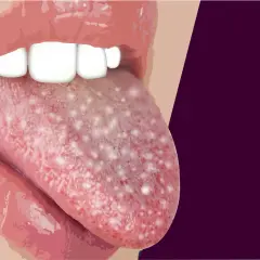 Lingua con puntini bianchi visibili, che potrebbero indicare una condizione medica.