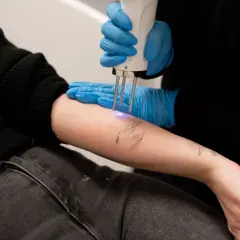 En person får en tatuering borttagen med laser. Undrar du över ta bort tatuering pris?
