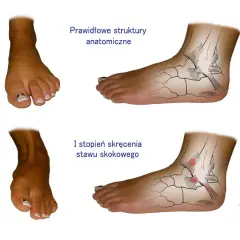 Po tym, jak krzywo stanąłem i boli mnie kostka, porównuję prawidłowe struktury anatomiczne stawu skokowego z I stopniem skręcenia.
