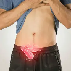 Hombre con un bulto en la ingle, representado con un área roja brillante en la zona abdominal inferior.