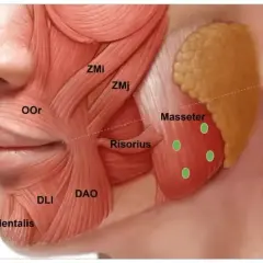 Anatomia mięśnia żwacza, z zaznaczonymi punktami iniekcji botoksu. Pomocne w leczeniu bruksizmu.
