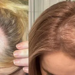 Före- och efterbilder som visar förbättring av androgent håravfall. Till vänster syns en kal fläck på en ljusblond hårbotten, till höger tätare, mörkare hår.