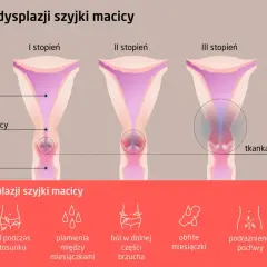 Grafika pokazuje stadia dysplazji szyjki macicy: I, II i III stopień, z zaznaczonymi objawami jak ból, plamienia i podrażnienie.