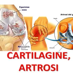 Illustrazione anatomica del ginocchio con artrosi, che mostra lesioni cartilaginee, esposizione ossea e osteofiti. Il ginocchio si piega al ginocchio.