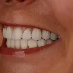 Piękne, białe zęby po wybielaniu. Czy wybielanie zębów boli? Nie, jeśli jest wykonane profesjonalnie.