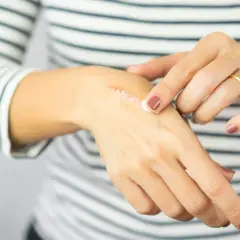 Dłoń z widoczną blizną, na którą aplikowana jest maść. Dbanie o ranę, by nie powstała ziarnina.