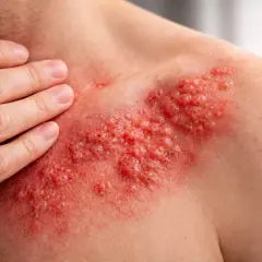 Eruzione cutanea rossa e vescicolare sul petto, che ricorda il fuoco di Sant'Antonio. Si cercano rimedi per alleviare il prurito e il dolore.