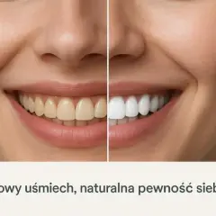 Przed i po: żółte zęby stają się białe dzięki bezpiecznemu wybielaniu zębów. Uśmiech pełen blasku i pewności siebie.