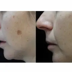 Comparación de piel con manchas solares antes y después de un tratamiento.