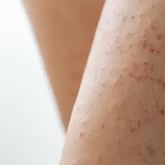Närbild på ben med keratosis pilaris, små röda prickar som ger en knottrig hudtextur.