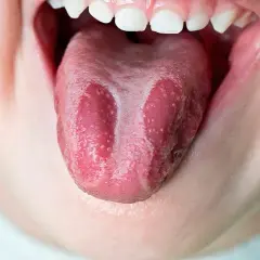 Lengua geográfica con parches blancos y rosados, como un mapa de sabores.