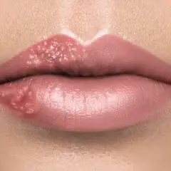 Opryszczka na ustach a dentysta: Kiedy wizyta jest bezpieczna?