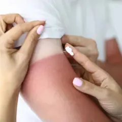 Application de crème pour désinfecter une brûlure solaire sur un bras rouge.