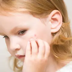 Niña con una pequeña lesión roja en la mejilla, posible signo de impétigo en niños.