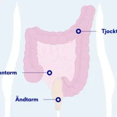 Illustration av tjocktarm, tunntarm och ändtarm. En koloskopi kamera kan undersöka dessa delar.