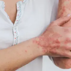 Skóra dłoni i przedramienia pokryta łuszczącymi się, czerwonymi zmianami, wskazującymi na choroby autoimmunologiczne skóry.