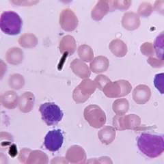 Blutausstrich mit Lymphozyten und Erythrozyten. Die Anzahl der Lymphozyten kann Hinweise auf die cll lebenserwartung geben.