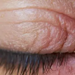 Gros plan sur un œil fermé, montrant la peau ridée et sèche de la paupière, signe d'une irritation paupière.