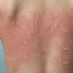 Schiena di un bambino con eritema e pomfi, segni tipici di orticaria. Come riconoscerla nei più piccoli.