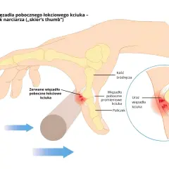 Naderwane więzadło kciuka objawy: ilustracja pokazuje uraz więzadła pobocznego łokciowego kciuka, tzw. kciuk narciarza.