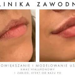 Kwas hialuronowy na usta: Nawilżenie czy powiększanie? Poznaj prawdę